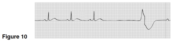 The rhythm in Figure 10 is   A) Sinus rhythm with occasional PACs. B) Sinus bradycardia with PVC. C) Sinus rhythm with a sinus arrest and a ventricular escape beat. D) Idioventricular rhythm.