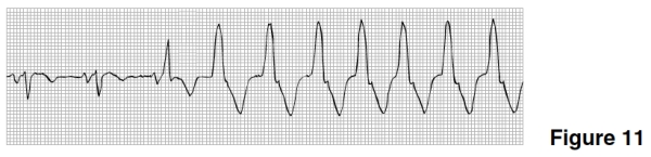 The rhythm in Figure 11 is   A) Atrial fibrillation. B) Atrial flutter. C) Sinus rhythm with a burst of PAT. D) Sinus rhythm converting to ventricular tachycardia.