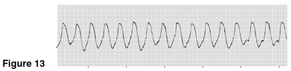 The rhythm in Figure 13 is   A) Atrial flutter. B) Ventricular fibrillation. C) Atrial tachycardia. D) Ventricular tachycardia.