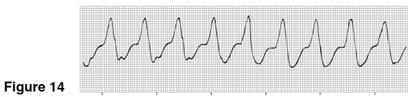 The heart rate in Figure 14 is closest to   A) 150. B) 100. C) 75. D) 60.