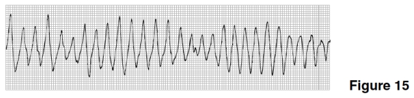 The rhythm in Figure 15 is   A) Agonal rhythm. B) Ventricular tachycardia. C) Torsades de pointes. D) Ventricular fibrillation.