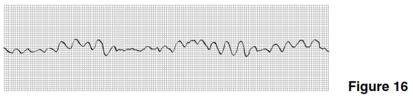 Treatment for the rhythm in Figure 16 would include which of the following?   A) Electrical shock to the heart B) Atropine C) Digitalis D) Oxygen removal