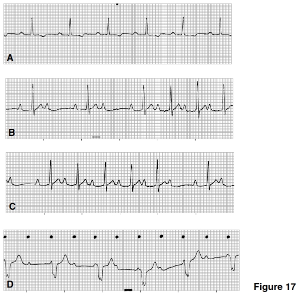 Which strip in Figure 17 is consistent with sinus rhythm with first-degree AV block?   A) A B) B C) C D) D