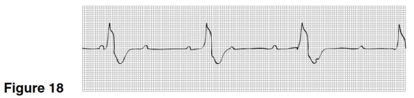 The PR interval in Figure 18   A) Is constant. B) Varies. C) Is about 0.12 seconds. D) Is about 0.20 seconds.