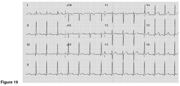 There is evidence of which of the following in Figure 19?   A) Slight ST segment elevation in multiple leads B) Significant Q waves in II,III,and AVF C) Inverted T waves in V1-6 D) Widespread ST depression and T wave inversions