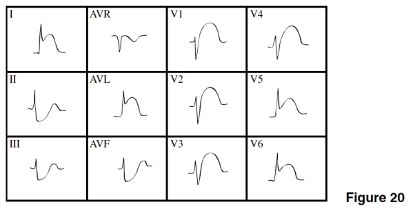 The age of the MI in Figure 20 is   A) Acute. B) Age indeterminate. C) Old. D) Impossible to tell.