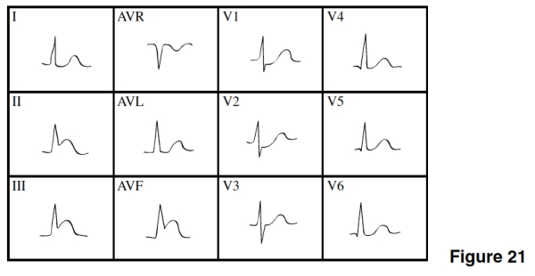 In Figure 21,there is evidence of   A) Anterior wall ischemia. B) Anterior MI. C) NSTEMI. D) Inferior/posterior MI
