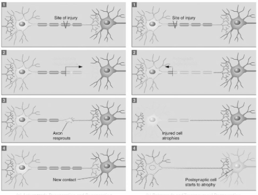   Box 4 on the right side of this figure (postsynaptic cell starts to atrophy) illustrates the process of A)  retrograde degeneration. B)  anterograde degeneration. C)  transneuronal degeneration. D)  cell adhesion.