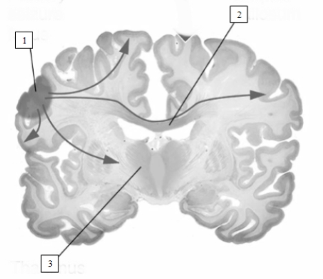 <strong> This image illustrates a</strong> A) partial seizure. B) grand mal seizure. C) petit mal seizure. D) migraine headache.