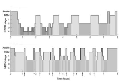 see Figure 16.17​    -The pattern of sleep indicated in the lower half of this image is typical of people who have been diagnosed with  A) schizophrenia.  B) bipolar disorder.  C) major depressive disorder.  D) autism.