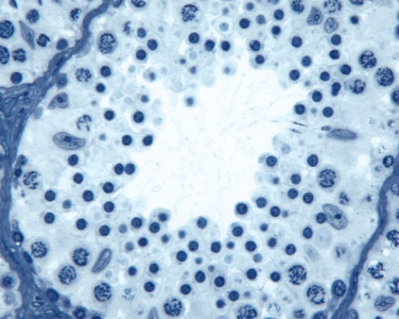 In Fig. Img_007, this is a healthy region in a patient suffering from cancer of the   A)  ovary B)  testis C)  prostate D)  cervix E)  breast