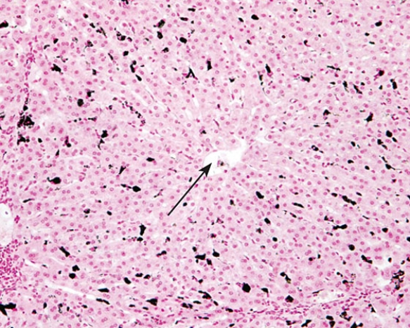 The tip of the arrow is located in the   A)  space of Disse B)  bile duct C)  portal area D)  central vein E)  hepatic sinus
