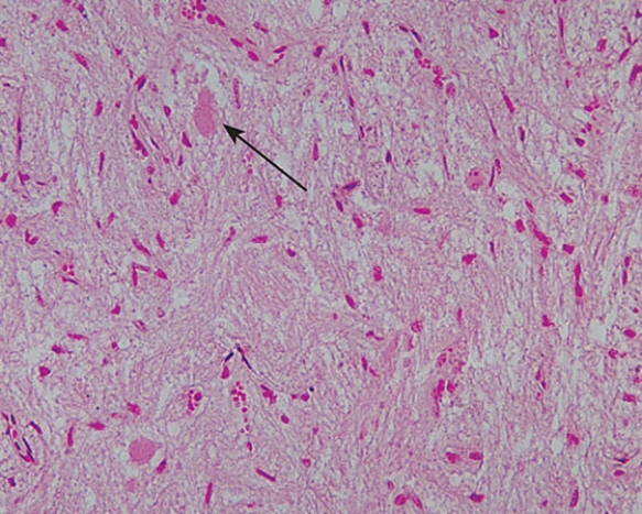 The structure indicated by the arrow contains which of the following substances?   A)  thyroglobulin B)  oxytocin C)  triglyceride D)  glycogen E)  milk