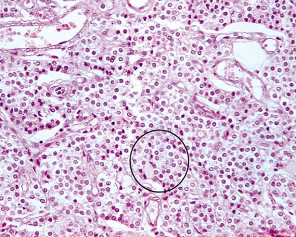 The cells located within the circle produce which of the following?   A)  antibodies B)  calcitonin C)  parathyroid hormone D)  osteoclast-stimulating factor E)  norepinephrine
