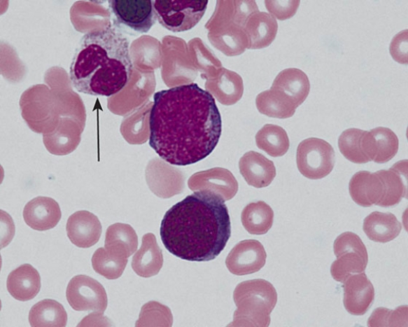 The cell indicated by the arrow is a   A)  neutrophil B)  neutrophilic metamyelocyte C)  eosinophilic metamyelocyte D)  eosinophilic myelocyte E)  promyelocyte