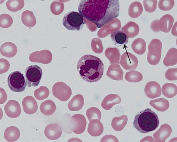 The cell at the tip of the arrow is a   A)  lymphocyte B)  basophilic erythroblast C)  promonocyte D)  polychromatophilic erythroblast E)  orthochromatophilic erythroblast