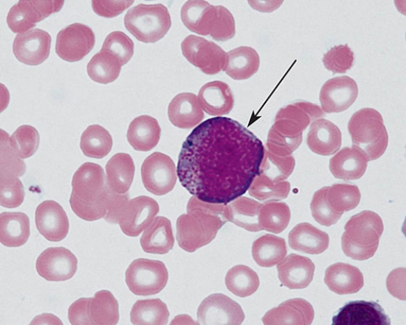 The cell at the tip of the arrow is a(n)    A)  eosinophilic metamyelocyte B)  neutrophilic metamyelocyte C)  basophilic metamyelocyte D)  promyelocyte E)  myeloblast