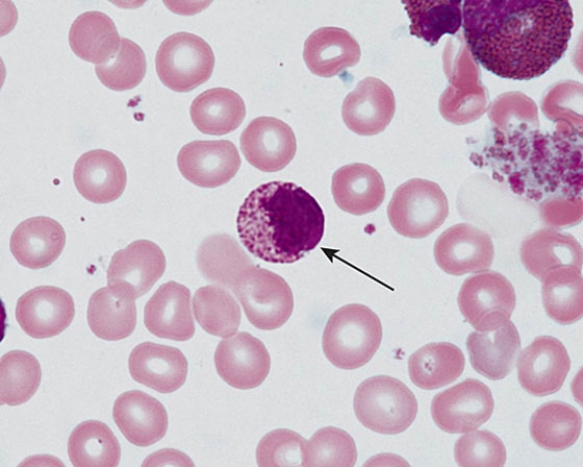The cell at the tip of the arrow is a(n)    A)  basophilic metamyelocyte B)  basophilic myelocyte C)  neutrophilic myelocyte D)  eosinophilic metamyelocyte E)  eosinophilic myelocyte