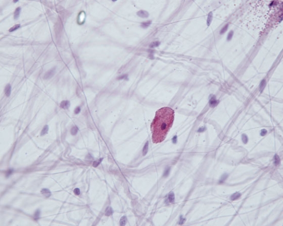 In Fig. Img_014, the large red cell in the middle of the field is responsible for which of the following conditions?   A)  anaphylactic shock B)  osteoblastoma C)  leukemia D)  chondroblastoma E) . fibroma