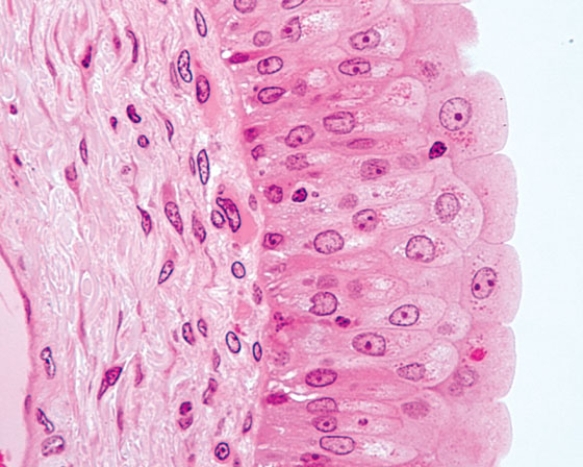 In Fig. Img_006, this is a healthy region in a patient suffering from cancer of the   A)  esophagus B)  skin C)  urinary bladder D)  gallbladder E)  cervix