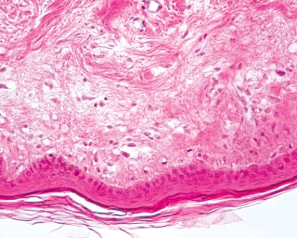 In Fig. Img_022, the epithelium at the free surface is classified as   A)  simple squamous B)  simple cuboidal C)  stratified squamous keratinized D)  stratified cuboidal E)  transitional