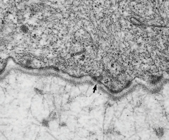 An elderly patient is seen by his dermatologist because he developed itching and blisters on his skin. If the blistering involves the region indicated by the arrows in this electron micrograph (Basallamina4) , and if the patient is shown to have IgG along the same area indicated by the arrows, the patient is probably suffering from   A)  dermatitis herpetiformis B)  atopic dermatitis C)  pemphigus vulgaris D)  pemphigus foliaceus E)  bullous pemphigoid