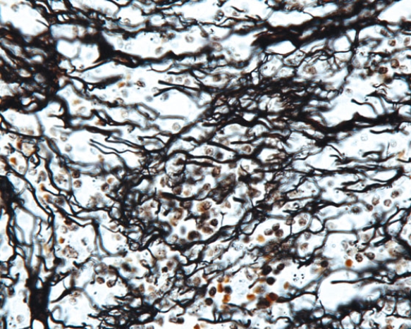 In Fig. Img_017, the predominant connective tissue element shown in this photomicrograph is a type of collagen fiber. Which type of collagen fiber is it?   A)  type I B)  type II C)  type III D)  type IV E)  type VII