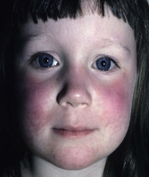 A clinic nurse is assessing a child with erythema infectiosum (fifth disease) .Which figure depicts the rash the nurse should expect to assess? A)     B)     C)     D)    
