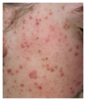 A clinic nurse is assessing a child with erythema infectiosum (fifth disease) .Which figure depicts the rash the nurse should expect to assess? A)     B)     C)     D)    
