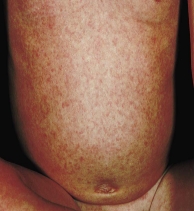 A clinic nurse is assessing a child with erythema infectiosum (fifth disease) .Which figure depicts the rash the nurse should expect to assess? A)     B)     C)     D)    