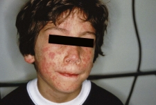 A clinic nurse is assessing a child with erythema infectiosum (fifth disease) .Which figure depicts the rash the nurse should expect to assess? A)     B)     C)     D)    