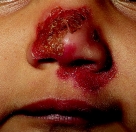 <strong>A school nurse assesses a case of tinea capitis (ringworm)on a 6-year-old child.Which figure depicts the characteristic lesion of tinea capitis?</strong> A) B) C) D)