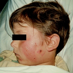 <strong>A school nurse assesses a case of tinea capitis (ringworm)on a 6-year-old child.Which figure depicts the characteristic lesion of tinea capitis?</strong> A) B) C) D)