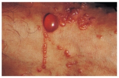 <strong>A school nurse assesses a case of tinea capitis (ringworm)on a 6-year-old child.Which figure depicts the characteristic lesion of tinea capitis?</strong> A) B) C) D)