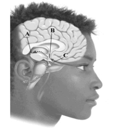 This image depicts key components involved in regulating your internal biological clock. Which of the labeled structures manufactures melatonin?   A)  pineal gland B)  suprachiasmatic nucleus C)  optic nerve D)  None of the answers is correct.