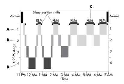This image depicts the sleep cycles over the course of a typica lnight. In which stage are night terrors most likely to occur?   A) stage 1 NREM B) stage 2 NREM C) REM sleep D) stage 4 NREM