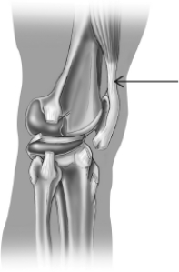 The structure that is highlighted in this illustration of a knee joint is a   A) bone. B) ligament. C) tendon. D) synovial sac.