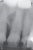 This bony hard radiopaque structure in the midline of the hard palate is genetic in origin and inherited in an autosomal dominant manner. The diagnosis is made through clinical appearance.   You suspect a: A) palatal cyst. B) torus palatinus. C) mixed tumor. D) ranula.