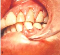 The gingival enlargement in this patient was caused by a calcium channel blocker.   Which one of the following would likely be the cause? A) Dilantin B) Nifedipine C) Quinidine D) Clozapine