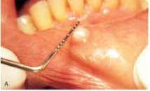 The base of this lesion would be described as:   A) pedunculated. B) lobule. C) bulla. D) sessile.