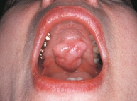 This torus palatinus would be described as:   A) bullous. B) papular. C) lobulated. D) nodular.