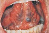 These reddish-purple clusters observed on the ventral surface of the tongue and diagnosed through clinical observation are referred to as which of the following variants of normal conditions?   A) Palatal cyst B) Mandibular tori C) Lingual varicosities D) Ranula