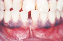 The variant of normal coloration seen on the mandibular gingival surface of this patient is referred to as:   A) lingual varicosities. B) leukoedema. C) melanin pigmentation. D) linea alba.
