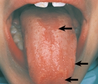 This pathological lesion seen on the dorsal surface of the tongue is characteristic of:   A) fissured tongue. B) hairy tongue. C) median rhomboid glossitis. D) migratory glossitis.