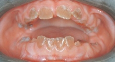 While obtaining diagnostic information from a patient, the dental hygienist learns that the appearance of this patient's teeth is familial. The correct diagnosis is:   A) tetracycline staining. B) pulpal dysplasia. C) extrinsic staining. D) dentinogenesis imperfecta.