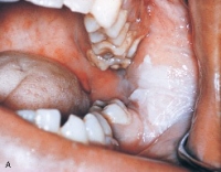 A patient comes to the office for an emergency visit. The patient complains of a toothache in the left mandibular posterior area. On clinical examination you notice a gray-to-white patch on the left posterior buccal mucosa. On questioning, the patient tells you that this area is also painful. After reviewing the patient's medical history, you question the patient regarding his recent use of:   A) hydrogen peroxide. B) aspirin. C) antibiotics. D) mouthwash.