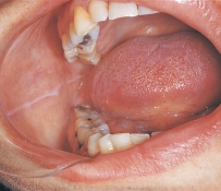 This white raised line observed on the buccal mucosa along the occlusal plane of the teeth is:   A) cheek biting. B) linea alba. C) white sponge nevus. D) frictional keratosis.