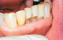 This type of erosion is classically associated with:   A) anorexia nervosa. B) bulimia. C) sucking lemons. D) abrasive toothpaste.