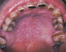 This lesion on the palate is typically associated with heavy pipe and cigar smoking and is called:   A) tobacco pouch keratosis. B) necrotizing sialometaplasia. C) nicotine stomatitis. D) frictional keratosis.