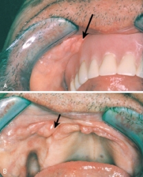 These elongated folds of tissue are a result of irritation from an ill-fitting denture.   The accurate diagnosis for this lesion is: A) palatal papillomatosis. B) gingival hyperplasia. C) chronic hyperplastic pulpitis. D) epulis fissuratum.